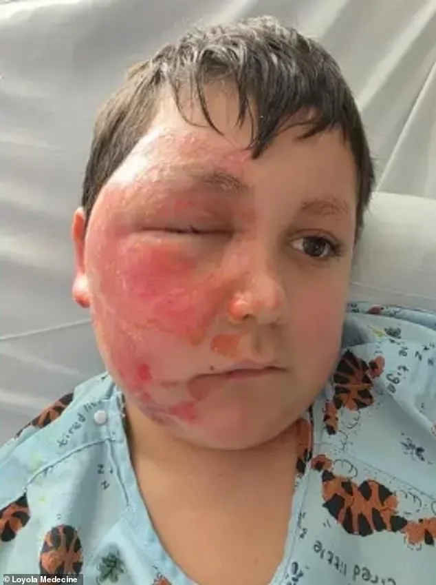 14-Year-Old Girl Hospitalized with Severe Burns After Attempting TikTok Fire-Breathing Challenge Using Isopropyl Alcohol
