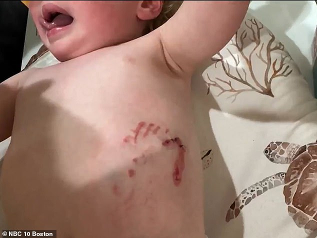 Two-year-old boy in Massachusetts hospitalized after raccoon attack at playground
