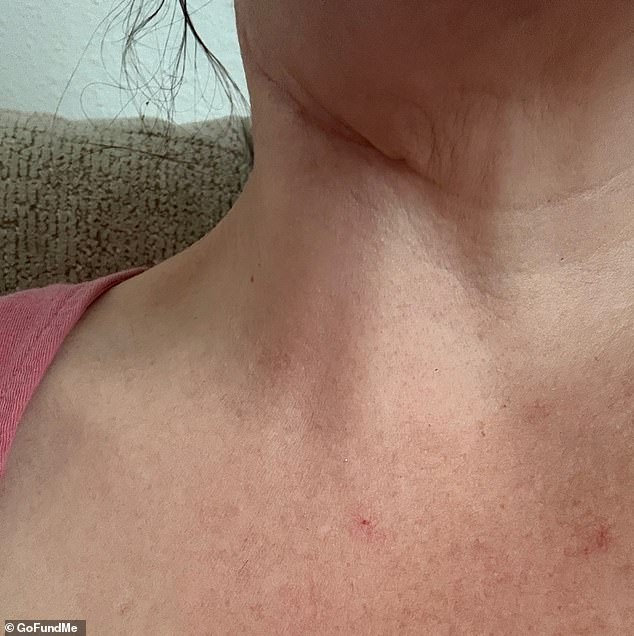 Doctor Rejections Delayed Florida Nurse's Diagnosis of Rare Tongue Cancer